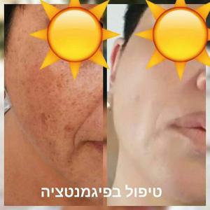 Процедуры для осветления кожи и удаления пигментации