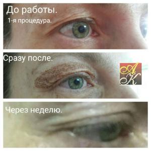 Безоперационная блефоропластика на аппарате LPP Plasma Pen;